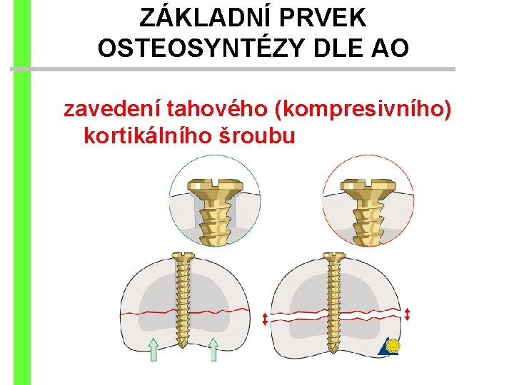ZÁKLADNÍ PRVEK OSTEOSYNTÉZY DLE AO zavedení tahového (kompresivního) kortikálního šroubu 