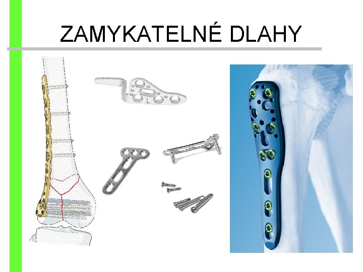 ZAMYKATELNÉ DLAHY 