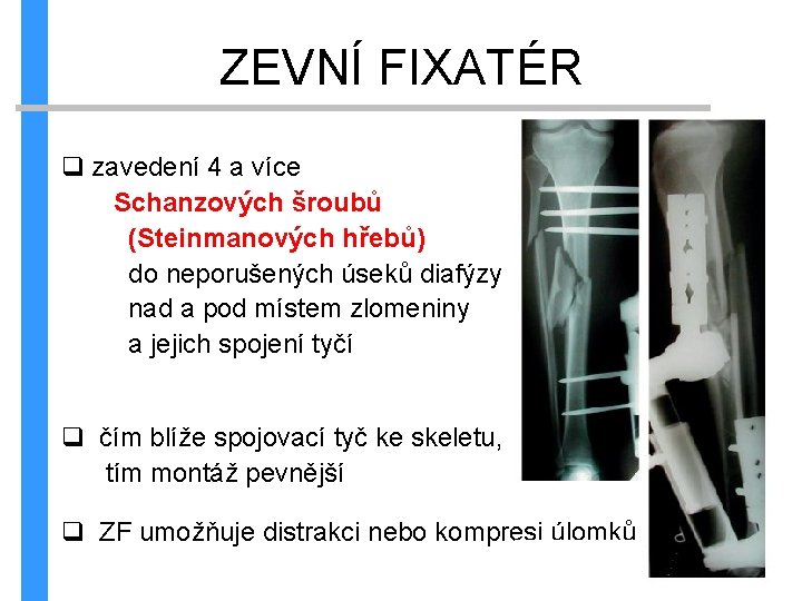 ZEVNÍ FIXATÉR q zavedení 4 a více Schanzových šroubů (Steinmanových hřebů) do neporušených úseků