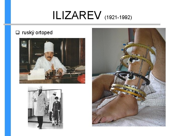 ILIZAREV (1921 -1992) q ruský ortoped 