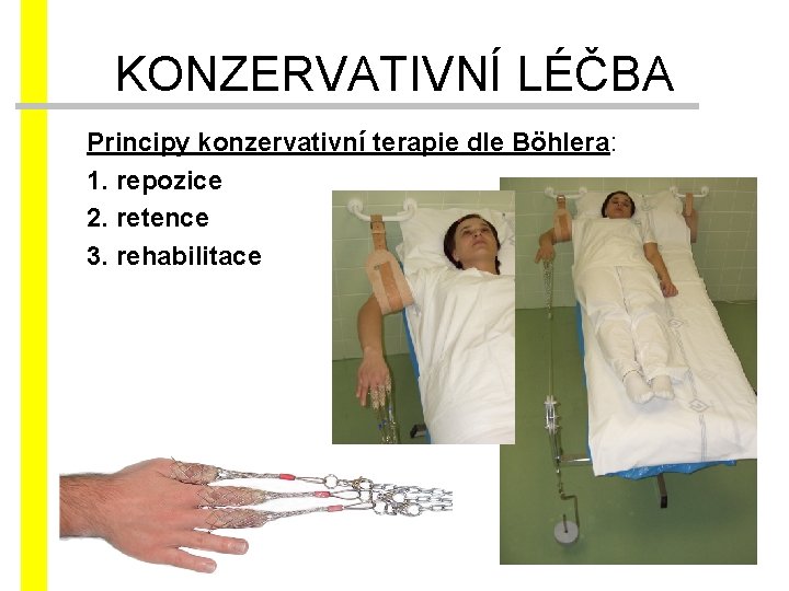 KONZERVATIVNÍ LÉČBA Principy konzervativní terapie dle Böhlera: 1. repozice 2. retence 3. rehabilitace 
