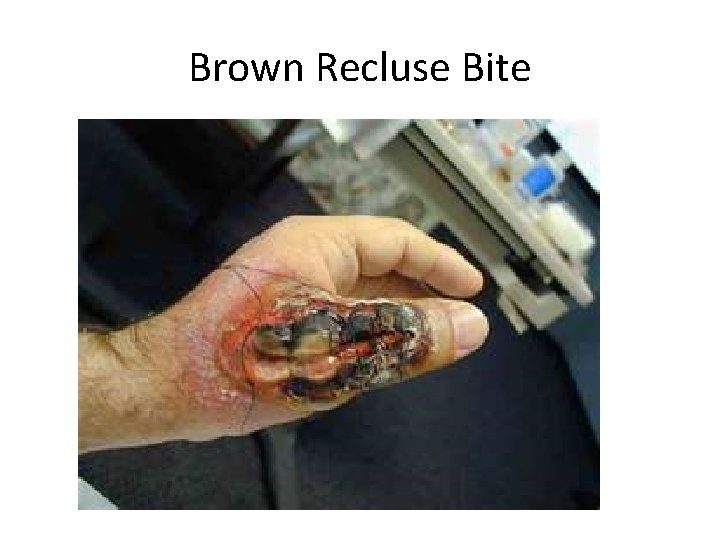 Brown Recluse Bite 