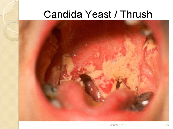 Candida Yeast / Thrush Winter 2013 25 