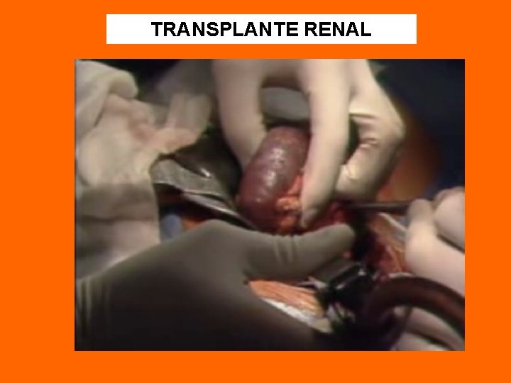 TRANSPLANTE RENAL 