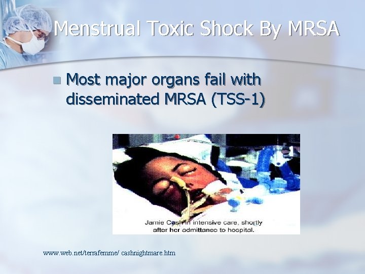 Menstrual Toxic Shock By MRSA n Most major organs fail with disseminated MRSA (TSS-1)