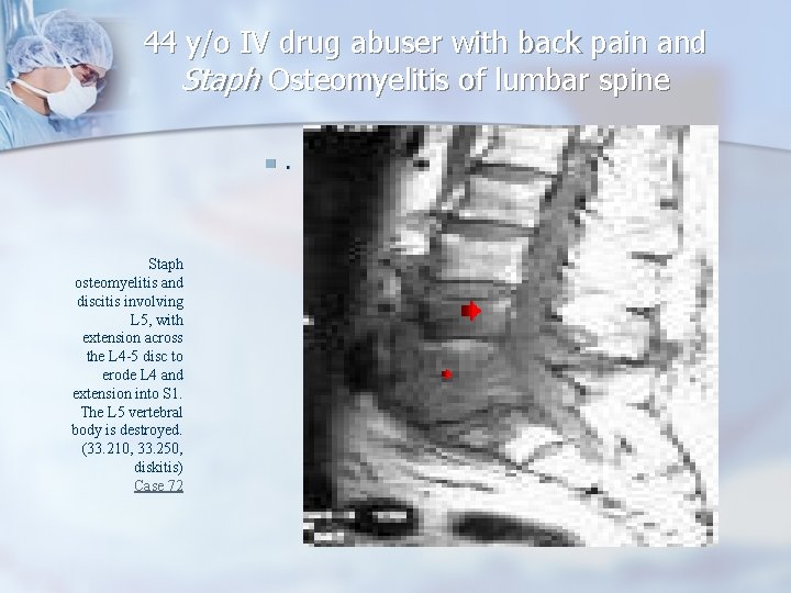 44 y/o IV drug abuser with back pain and Staph Osteomyelitis of lumbar spine