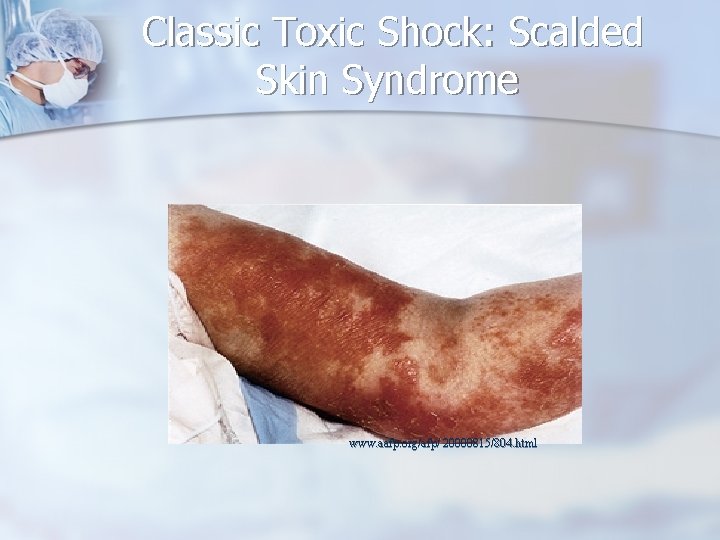 Classic Toxic Shock: Scalded Skin Syndrome www. aafp. org/afp/ 20000815/804. html 