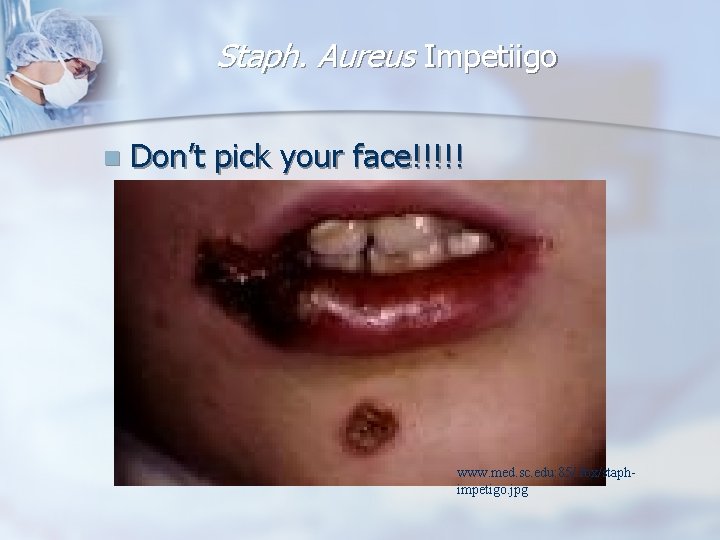 Staph. Aureus Impetiigo n Don’t pick your face!!!!! www. med. sc. edu: 85/ fox/staphimpetigo.