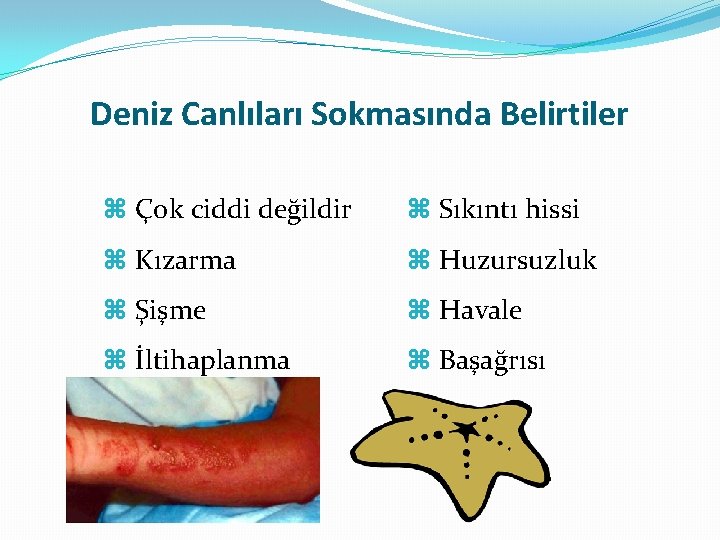 Deniz Canlıları Sokmasında Belirtiler Çok ciddi değildir Sıkıntı hissi Kızarma Huzursuzluk Şişme Havale İltihaplanma