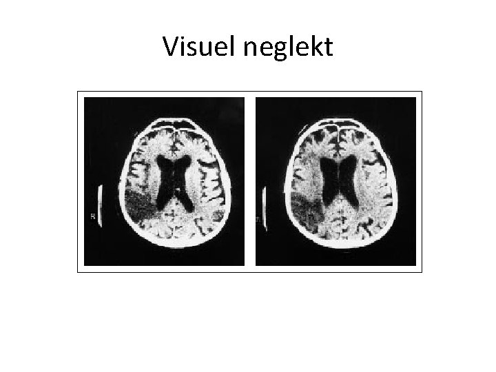 Visuel neglekt 