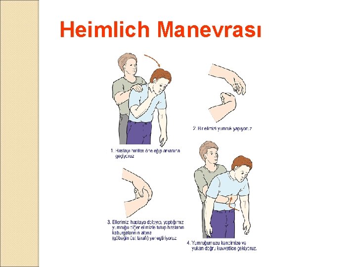 Heimlich Manevrası 