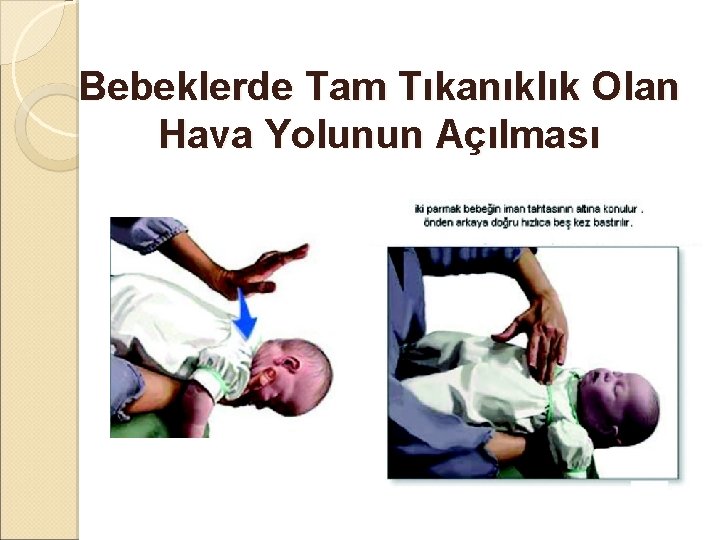 Bebeklerde Tam Tıkanıklık Olan Hava Yolunun Açılması 