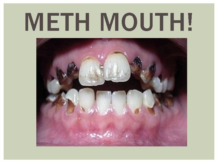 METH MOUTH! 