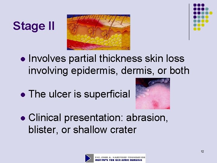 Stage II l Involves partial thickness skin loss involving epidermis, or both l The