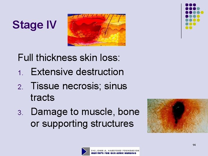 Stage IV Full thickness skin loss: 1. Extensive destruction 2. Tissue necrosis; sinus tracts