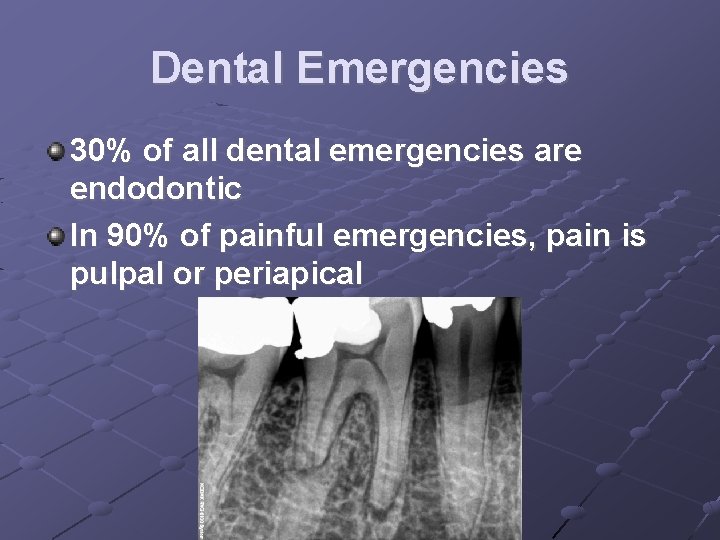 Dental Emergencies 30% of all dental emergencies are endodontic In 90% of painful emergencies,