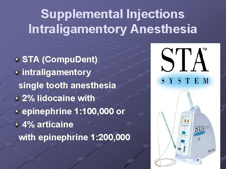 Supplemental Injections Intraligamentory Anesthesia STA (Compu. Dent): intraligamentory single tooth anesthesia 2% lidocaine with