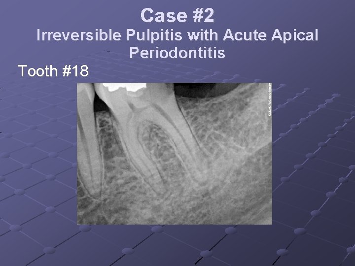 Case #2 Irreversible Pulpitis with Acute Apical Periodontitis Tooth #18 