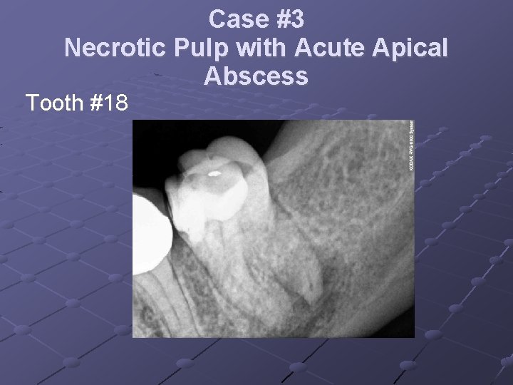 Case #3 Necrotic Pulp with Acute Apical Abscess Tooth #18 