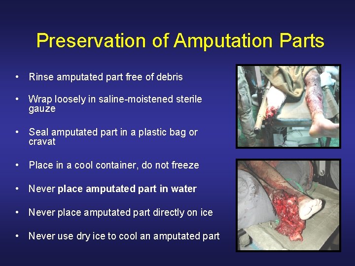 Preservation of Amputation Parts • Rinse amputated part free of debris • Wrap loosely