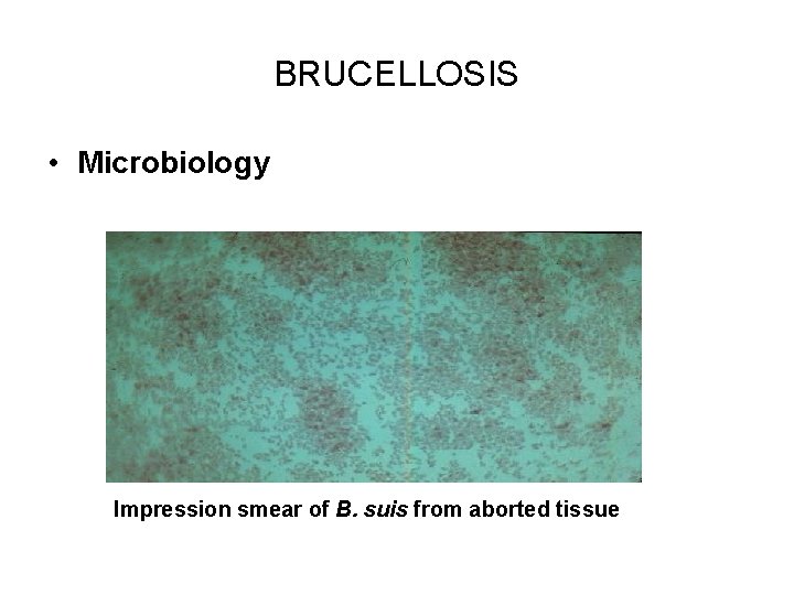 BRUCELLOSIS • Microbiology Impression smear of B. suis from aborted tissue 