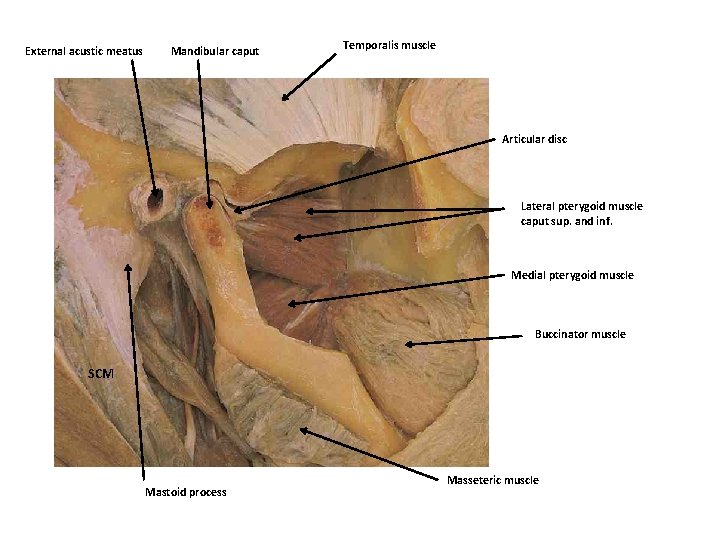 External acustic meatus Mandibular caput Temporalis muscle Articular disc Lateral pterygoid muscle caput sup.