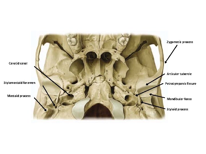 Zygomatic process Carotid canal Articular tubercle Stylomastoid foramen Mastoid process Petrotympanic fissure Mandibular fossa