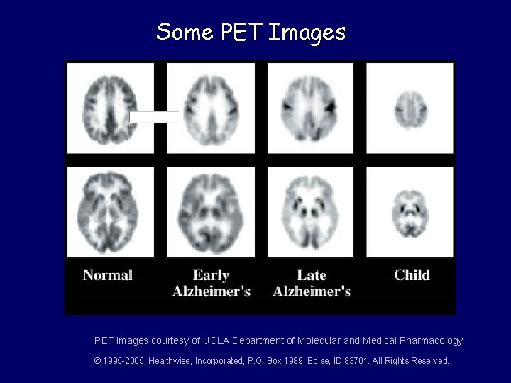 Some PET Images PET images courtesy of UCLA Department of Molecular and Medical Pharmacology