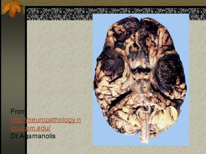 From http: //neuropathology. n eoucom. edu/ Dr. Agamanolis 