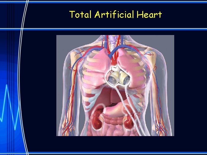 Total Artificial Heart 