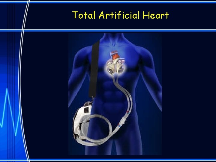 Total Artificial Heart 