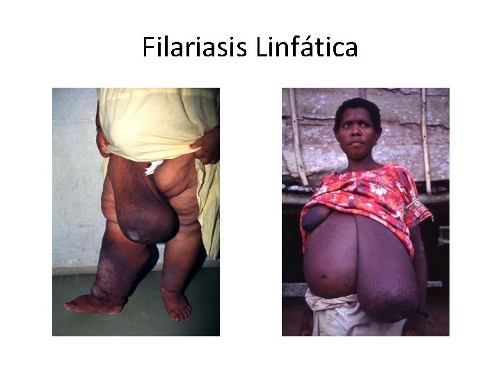Filariasis Linfática 