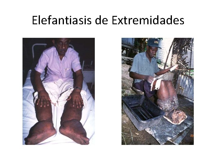 Elefantiasis de Extremidades 