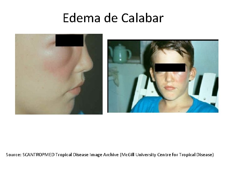 Edema de Calabar Source: SCANTROPMED Tropical Disease Image Archive (Mc. Gill University Centre for