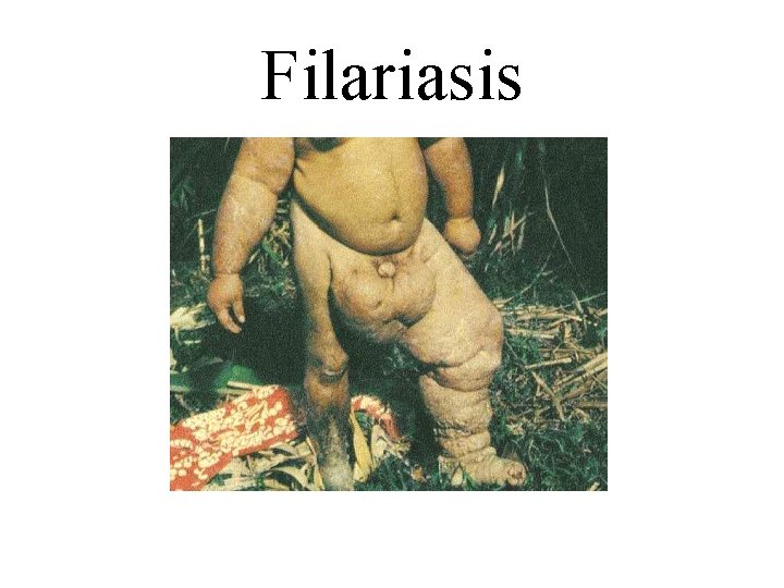 Filariasis 