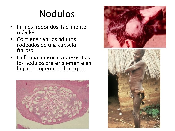 Nodulos • Firmes, redondos, fácilmente móviles • Contienen varios adultos rodeados de una cápsula