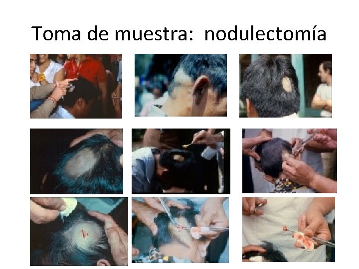 Toma de muestra: nodulectomía 