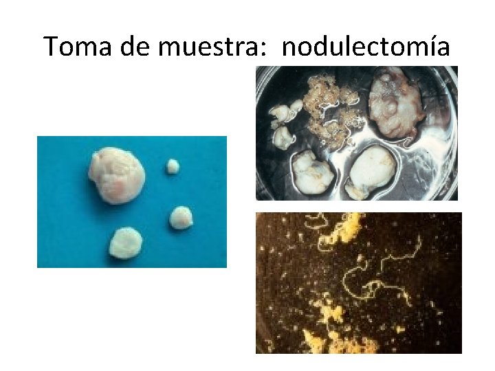 Toma de muestra: nodulectomía 