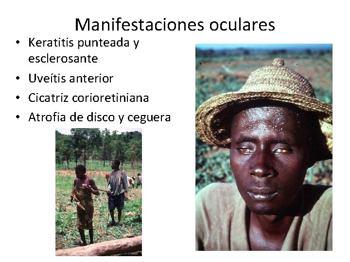 Manifestaciones oculares • Keratitis punteada y esclerosante • Uveítis anterior • Cicatriz corioretiniana •