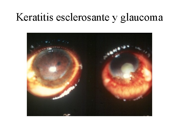 Keratitis esclerosante y glaucoma 