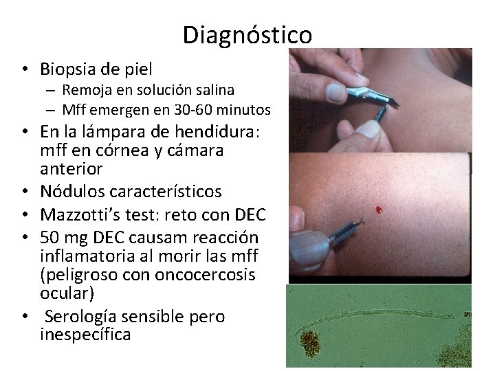Diagnóstico • Biopsia de piel – Remoja en solución salina – Mff emergen en