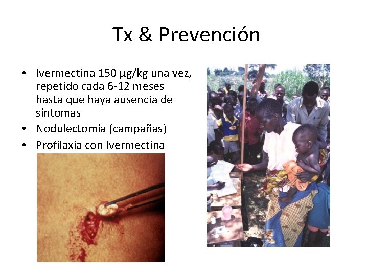 Tx & Prevención • Ivermectina 150 µg/kg una vez, repetido cada 6 -12 meses