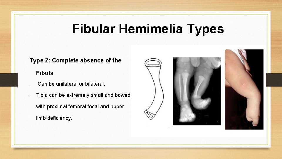 Group 3 Fibular Hemimelia Alina Bodea Co Presenter