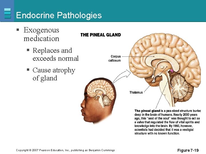 Endocrine Pathologies § Exogenous medication § Replaces and exceeds normal § Cause atrophy of