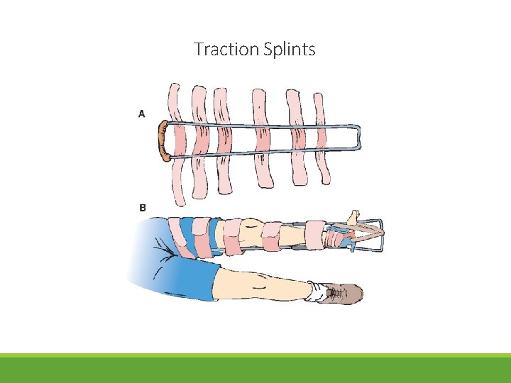 Traction Splints 