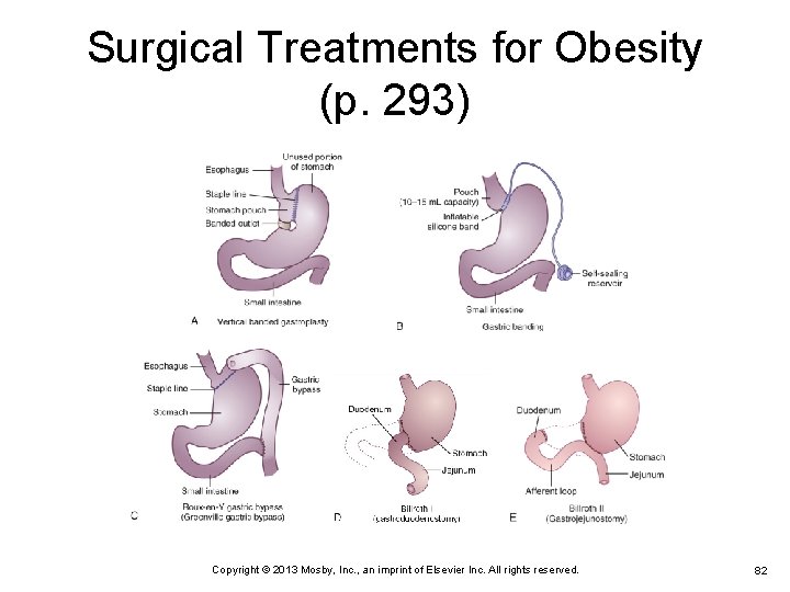 Surgical Treatments for Obesity (p. 293) Copyright © 2013 Mosby, Inc. , an imprint