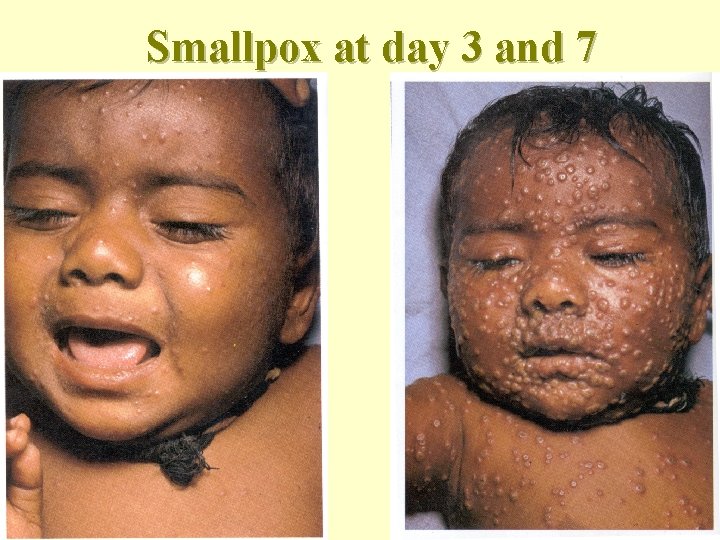 Smallpox at day 3 and 7 