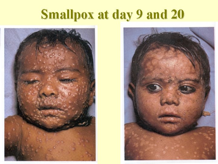 2 sites on smallpox Center for Disease Control