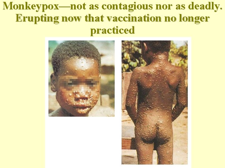 Monkeypox—not as contagious nor as deadly. Erupting now that vaccination no longer practiced 