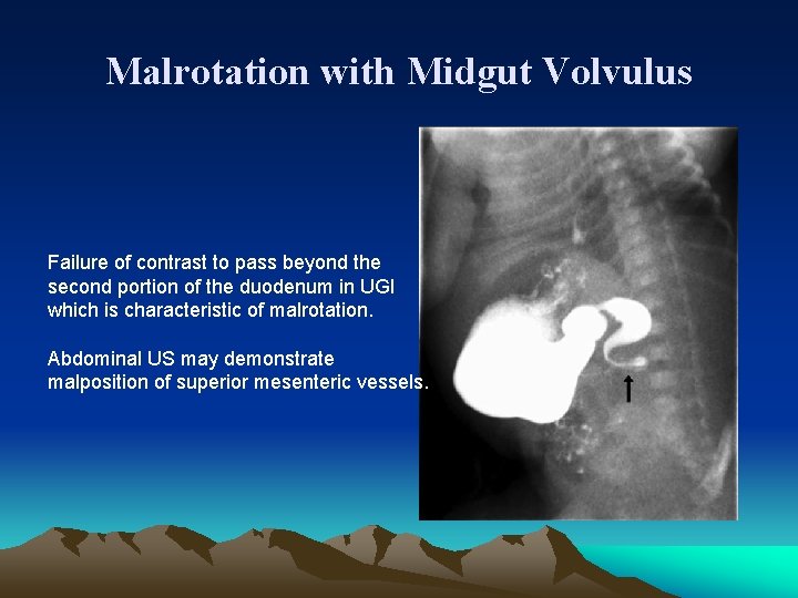 Malrotation with Midgut Volvulus Failure of contrast to pass beyond the second portion of